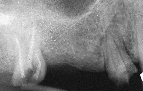 severely decayed teeth