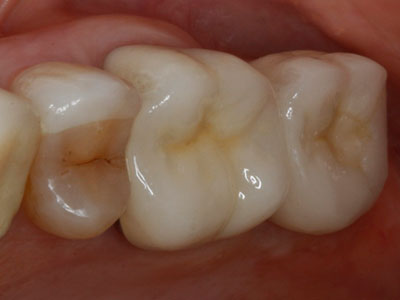 Armstrong-after-implant