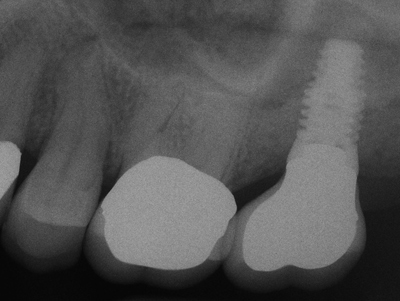 single-posterior-after-x-ray