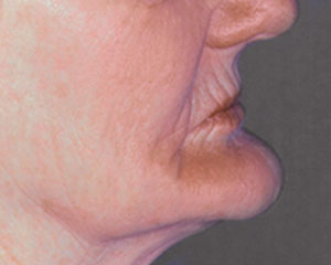 facial structure collapse 